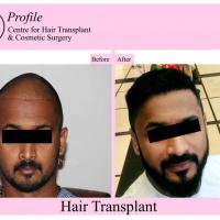 Hair Transplantation in Palakkad, Kerala | India
